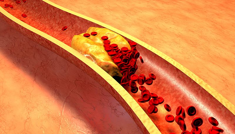 ”Dårlig” LDL-kolesterol motvirker infeksjoner / 2020 / Helsemagasinet vitenskap og fornuft