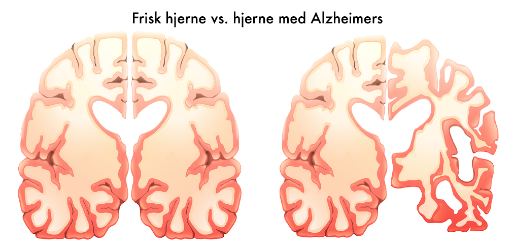 frisk hjerne vs hjerne med alzheimers